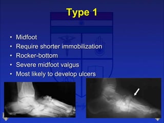 Type 1
• Midfoot
• Require shorter immobilization
• Rocker-bottom
• Severe midfoot valgus
• Most likely to develop ulcers
 