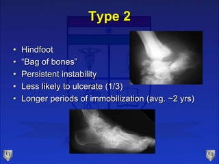 Type 2
• Hindfoot
• “Bag of bones”
• Persistent instability
• Less likely to ulcerate (1/3)
• Longer periods of immobilization (avg. ~2 yrs)
 