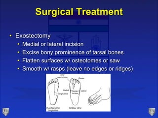 Surgical Treatment
• Exostectomy
• Medial or lateral incision
• Excise bony prominence of tarsal bones
• Flatten surfaces w/ osteotomes or saw
• Smooth w/ rasps (leave no edges or ridges)
 