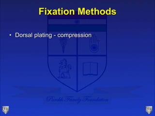 Fixation Methods
• Dorsal plating - compression
 