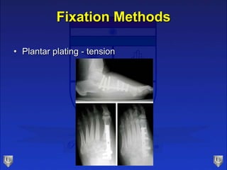 Fixation Methods
• Plantar plating - tension
 