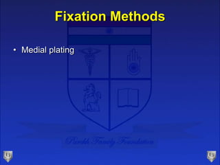 Fixation Methods
• Medial plating
 