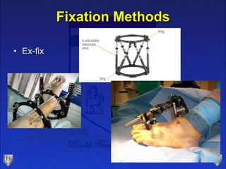 Fixation Methods
• Ex-fix
 