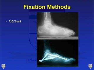 Fixation Methods
• Screws
 