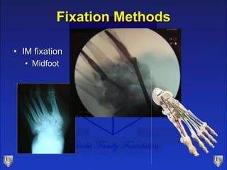 Fixation Methods
• IM fixation
• Midfoot
 
