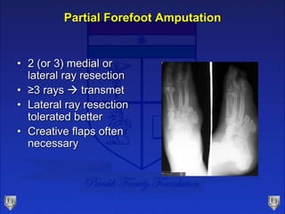 Lecture 31 parekh amputations | PPTX