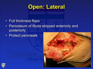 Open: Lateral
• Full thickness flaps
• Periosteum of fibula stripped anteriorly and
posteriorly
• Protect peroneals
 