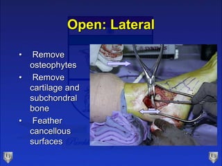 Open: Lateral
• Remove
osteophytes
• Remove
cartilage and
subchondral
bone
• Feather
cancellous
surfaces
 