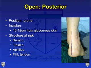 Open: Posterior
• Position: prone
• Incision
• 10-12cm from glabourous skin
• Structure at risk
• Sural n.
• Tibial n.
• A...