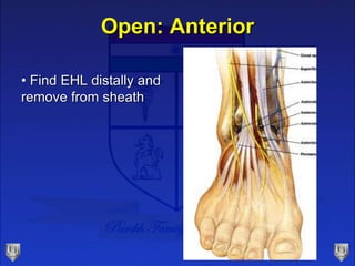 Open: Anterior
• Find EHL distally and
remove from sheath
 