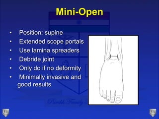 • Position: supine
• Extended scope portals
• Use lamina spreaders
• Debride joint
• Only do if no deformity
• Minimally i...