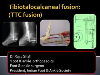Dr.Rajiv Shah
‘Foot & ankle orthopaedics’
Foot & ankle surgeon
President, Indian Foot & Ankle Society
 