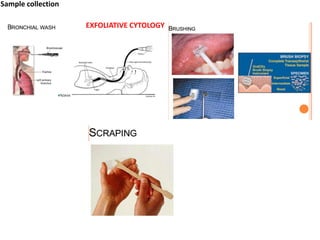 EXFOLIATIVE CYTOLOGY
Sample collection
 