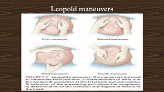 Leopold maneuvers
 