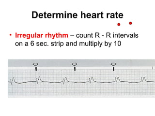 Irregular Rate Lecture 3 cardiac rhythms | PPT