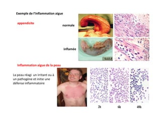 Exemple de l’inflammation aigue
appendicite
normale
inflamée
Inflammation aigue de la peau
La peau réagi un irritant ou à
...