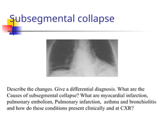 Subsegmental collapse
Describe the changes. Give a differential diagnosis. What are the
Causes of subsegmental collapse? What are myocardial infarction,
pulmonary embolism, Pulmonary infarction, asthma and bronchiolitis
and how do these conditions present clinically and at CXR?
 