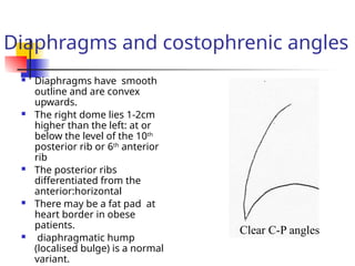 Diaphragms and costophrenic angles
 Diaphragms have smooth
outline and are convex
upwards.
 The right dome lies 1-2cm
higher than the left: at or
below the level of the 10th
posterior rib or 6th
anterior
rib
 The posterior ribs
differentiated from the
anterior:horizontal
 There may be a fat pad at
heart border in obese
patients.
 diaphragmatic hump
(localised bulge) is a normal
variant.
Clear C-P angles
 