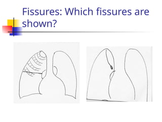 Fissures: Which fissures are
shown?
 