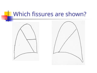 Which fissures are shown?
 
