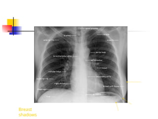 Breast
shadows
 