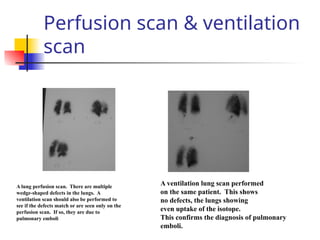 Perfusion scan & ventilation
scan
A lung perfusion scan. There are multiple
wedge-shaped defects in the lungs. A
ventilation scan should also be performed to
see if the defects match or are seen only on the
perfusion scan. If so, they are due to
pulmonary emboli
A ventilation lung scan performed
on the same patient. This shows
no defects, the lungs showing
even uptake of the isotope.
This confirms the diagnosis of pulmonary
emboli.
 