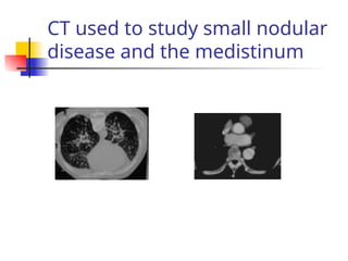 CT used to study small nodular
disease and the medistinum
 