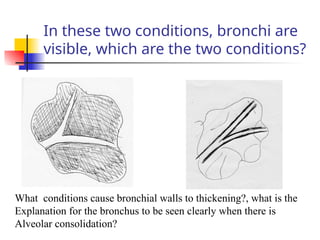 In these two conditions, bronchi are
visible, which are the two conditions?
What conditions cause bronchial walls to thickening?, what is the
Explanation for the bronchus to be seen clearly when there is
Alveolar consolidation?
 