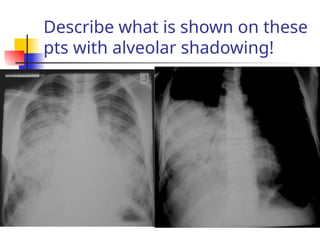 Describe what is shown on these
pts with alveolar shadowing!
 