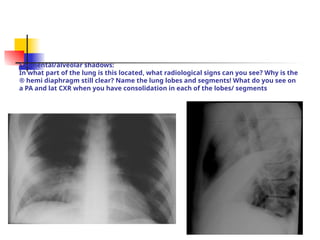 Segmental/alveolar shadows:
In what part of the lung is this located, what radiological signs can you see? Why is the
® hemi diaphragm still clear? Name the lung lobes and segments! What do you see on
a PA and lat CXR when you have consolidation in each of the lobes/ segments
 