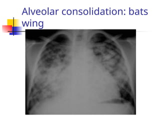 Alveolar consolidation: bats
wing
 