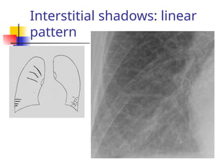 Interstitial shadows: linear
pattern
 