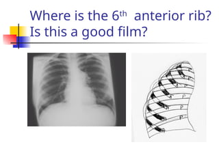 Where is the 6th
anterior rib?
Is this a good film?
 