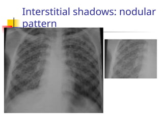 Interstitial shadows: nodular
pattern
 