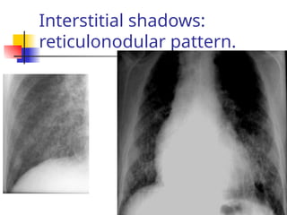 Interstitial shadows:
reticulonodular pattern.
 