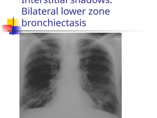 Interstitial shadows:
Bilateral lower zone
bronchiectasis
 