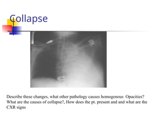Collapse
Describe these changes, what other pathology causes homogenous Opacities?
What are the causes of collapse?, How does the pt. present and and what are the
CXR signs
 