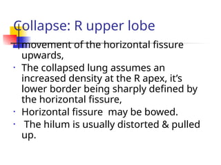 Collapse: R upper lobe
• movement of the horizontal fissure
upwards,
• The collapsed lung assumes an
increased density at the R apex, it’s
lower border being sharply defined by
the horizontal fissure,
• Horizontal fissure may be bowed.
• The hilum is usually distorted & pulled
up.
 