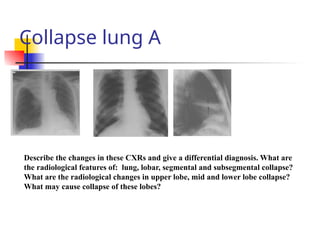 Collapse lung A
Describe the changes in these CXRs and give a differential diagnosis. What are
the radiological features of: lung, lobar, segmental and subsegmental collapse?
What are the radiological changes in upper lobe, mid and lower lobe collapse?
What may cause collapse of these lobes?
 
