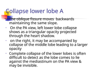 Collapse lower lobe A
• The oblique fissure moves backwards
maintaining the same slope.
• On the PA view, left lower lobe collapse
shows as a triangular opacity projected
through the heart shadow.
• on the right, it may be accompanied by
collapse of the middle lobe leading to a larger
opacity
• Complete collapse of the lower lobes is often
difficult to detect as the lobe comes to lie
against the mediastinum on the PA view &
may be invisible.
 