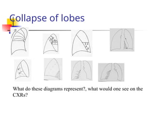 Collapse of lobes
What do these diagrams represent?, what would one see on the
CXRs?
 