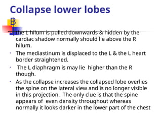 Collapse lower lobes
B
• the L hilum is pulled downwards & hidden by the
cardiac shadow normally should lie above the R
hilum.
• The mediastinum is displaced to the L & the L heart
border straightened.
• The L diaphragm is may lie higher than the R
though.
• As the collapse increases the collapsed lobe overlies
the spine on the lateral view and is no longer visible
in this projection. The only clue is that the spine
appears of even density throughout whereas
normally it looks darker in the lower part of the chest
 