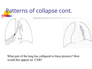 Patterns of collapse cont.
What part of the lung has collapsed in these pictures? How
would this appear on CXR?
 