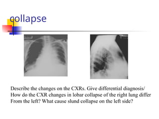 collapse
Describe the changes on the CXRs. Give differential diagnosis/
How do the CXR changes in lobar collapse of the right lung differ
From the left? What cause slund collapse on the left side?
 