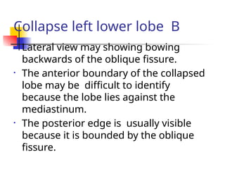 Collapse left lower lobe B
• Lateral view may showing bowing
backwards of the oblique fissure.
• The anterior boundary of the collapsed
lobe may be difficult to identify
because the lobe lies against the
mediastinum.
• The posterior edge is usually visible
because it is bounded by the oblique
fissure.
 