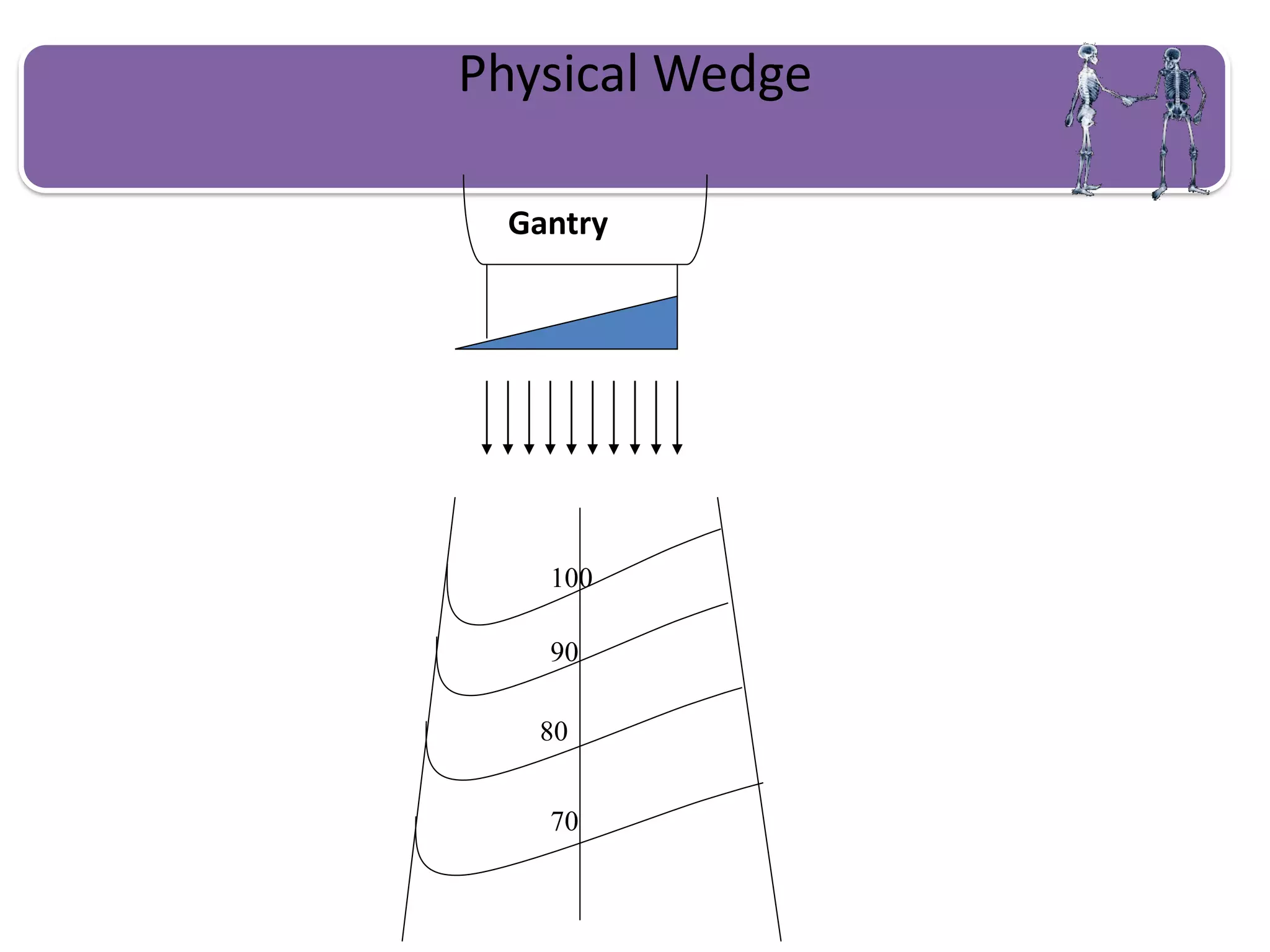 Physical Wedge
Gantry
100
90
80
70
 