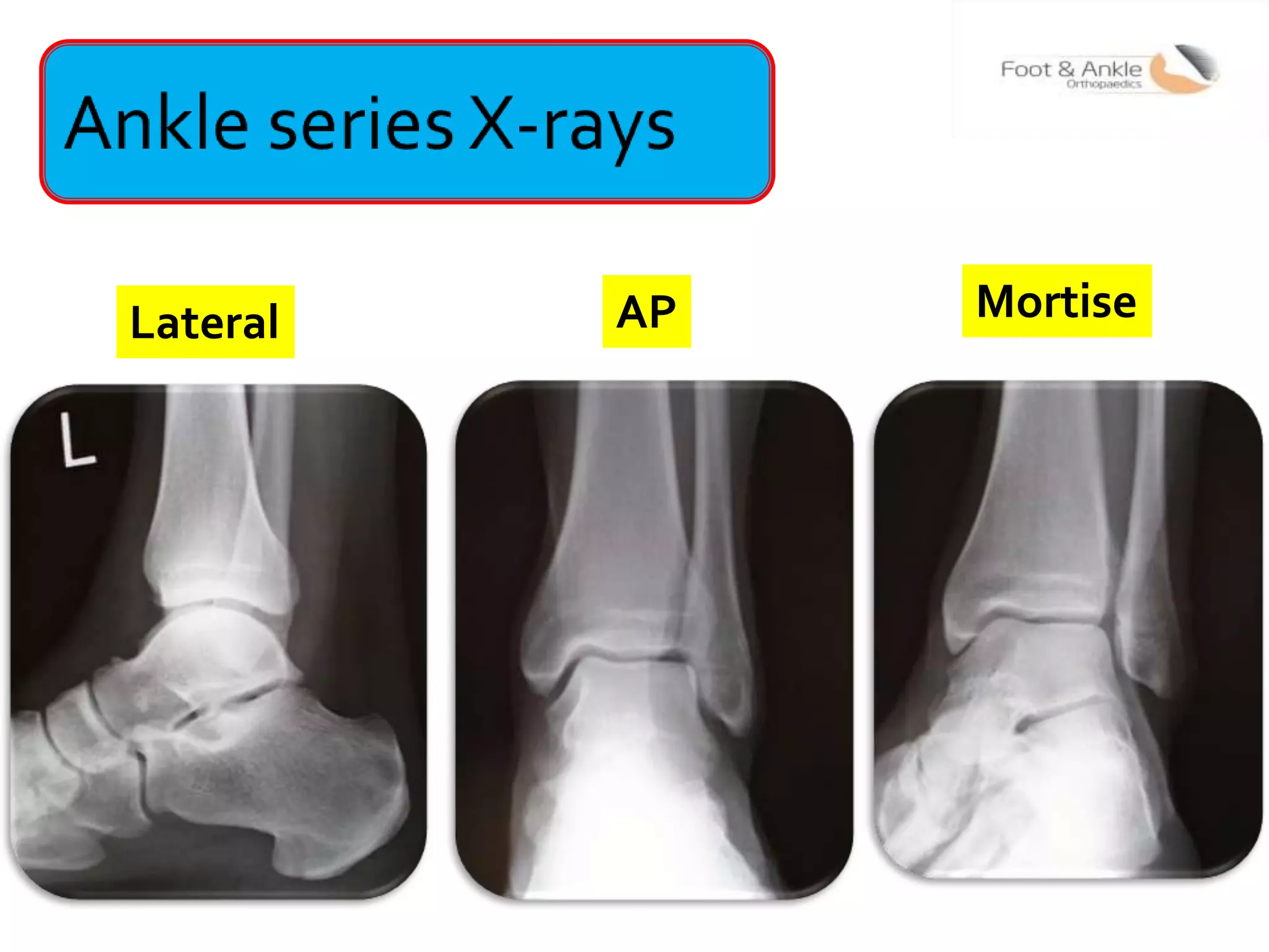 Ankle Rx Lecture 3 shah radiology in foot and ankle | PPTX
