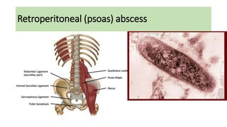 Retroperitoneal (psoas) abscess
 