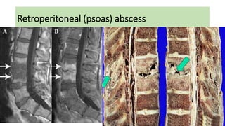 Retroperitoneal (psoas) abscess
 