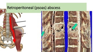 Retroperitoneal (psoas) abscess
 